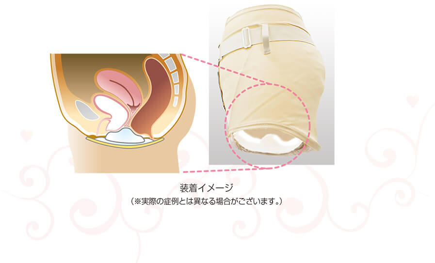 公式】フェミクッション：骨盤臓器脱(子宮脱・膀胱脱・膀胱瘤)の医療機器下着 | 女性医療研究所：医療機器の製造・販売